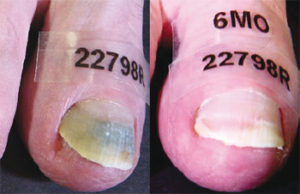 Infected Toenail (left) and Toenail 6 Months Post Treatment (Right)