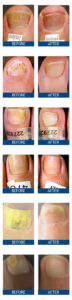 Do I Have Nail Fungus? Signs, Symptoms, and Next Steps Before and after laser nail therapy for nail fungus