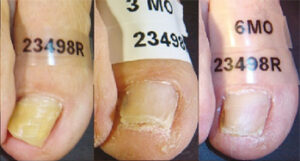 Do I Have Nail Fungus? Signs, Symptoms, and Next Steps Toenail infected with nail fungus