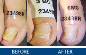 Fungus Toenails Treatment, Arlington, TX Ba Toe Img 300x192