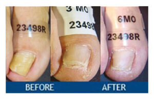 Toenail Fungus Treatment in Broomfield, CO Three Nails 300x193