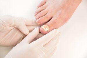 Locker Rooms and Toenail Fungus Fungus Toenails Treatment