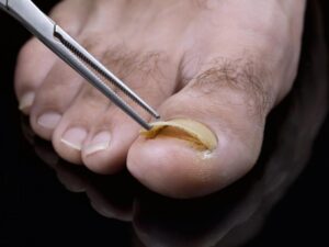Toenail Fungus Laser Treatment in Valrico, FL toenail fungus and pedicures