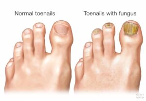 Visible Signs of Nail Fungus Toenail Fungus