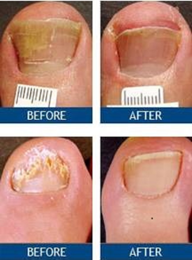 Toenail Fungus treatment benefits
