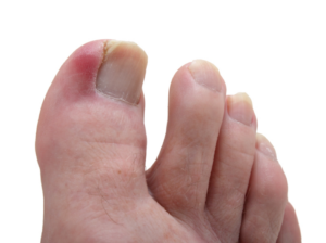 5 types of Toenail Problems Big Toe Infection