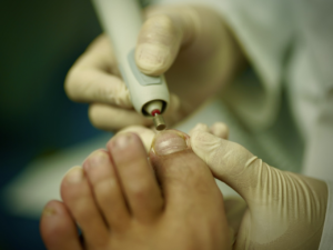 Diabetes Increases Risk for Nail Fungus. Here’s How Laser Therapy Can Help. Podiatrist Treating Toenail Carefully