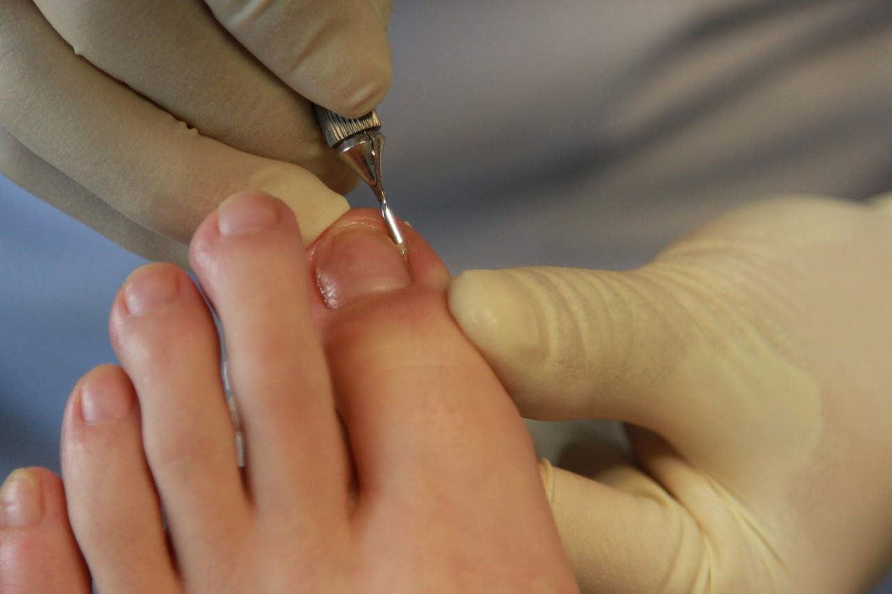 Breaking the Cycle: What Causes Toe Nail Fungus Relapse? Precise Toenail Treatment Ongoing